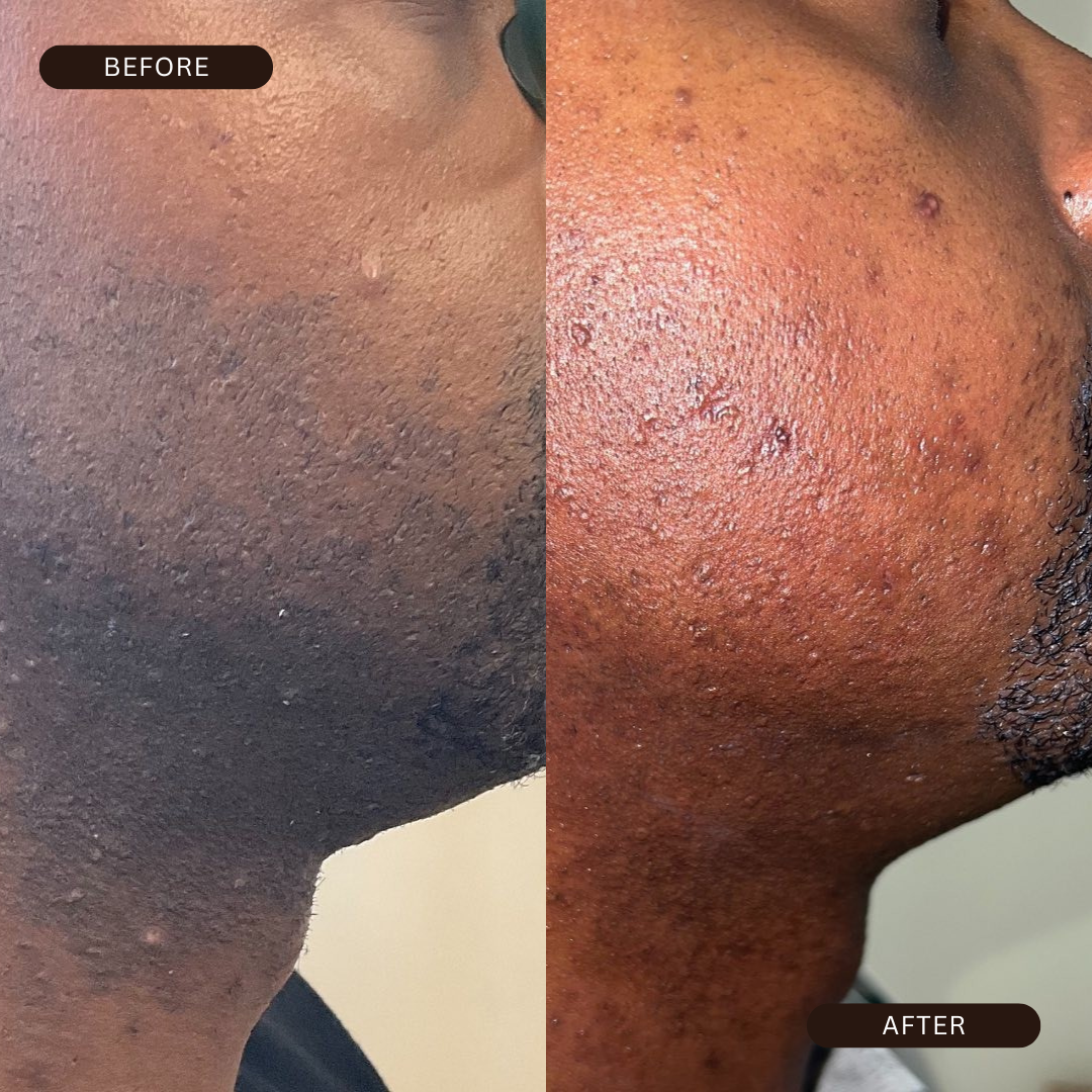 BeePropolis 48-Hour Razor Bump & Ingrown Relief Cream