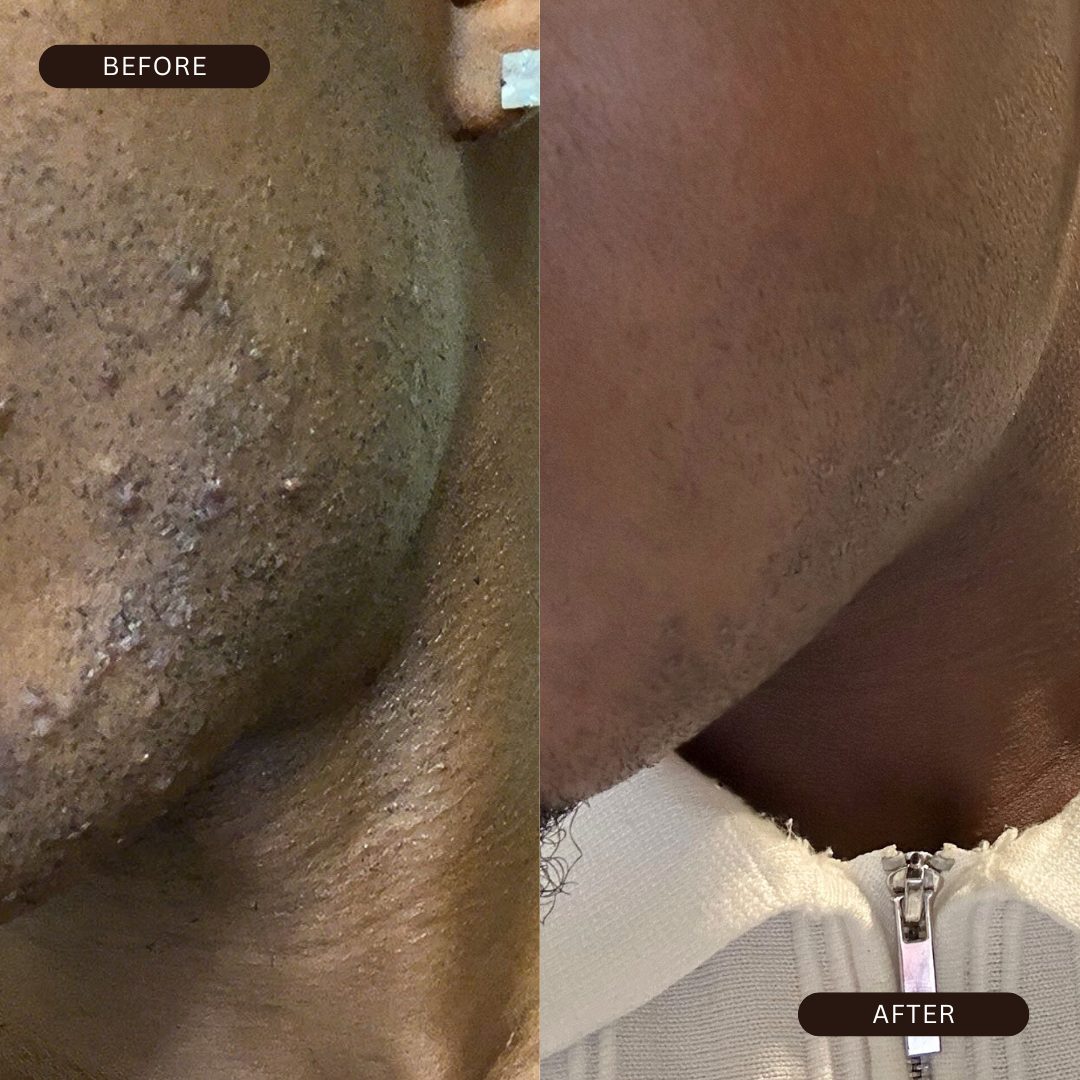 BeePropolis 48-Hour Razor Bump & Ingrown Relief Cream