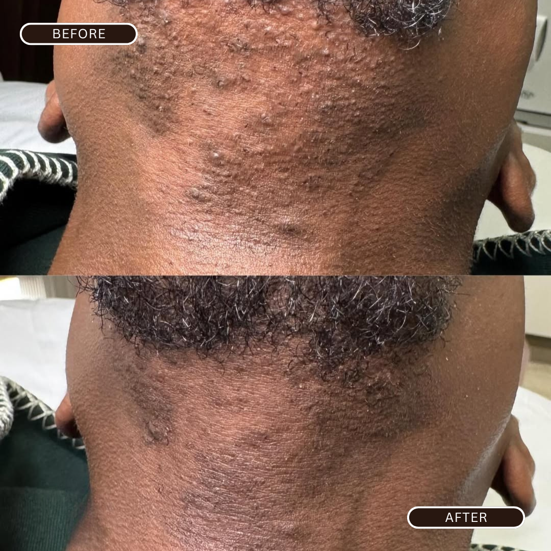 BeePropolis 48-Hour Razor Bump & Ingrown Relief Cream